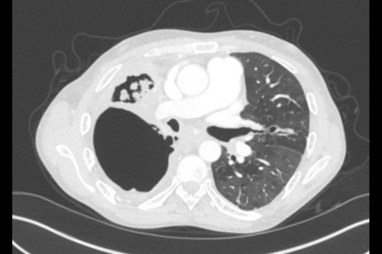 TB lungs 538x358 home page highlight size